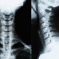 X-ray image of neck X-ray image of neck